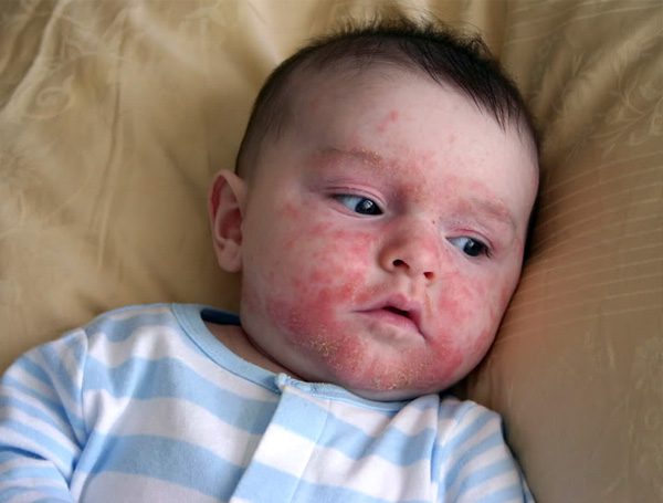 Cradle cap clearance on face